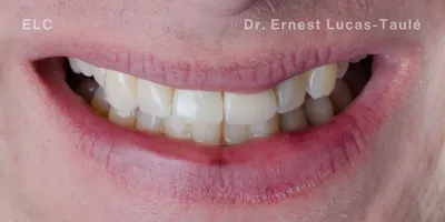 Close-up clinical view of the patient’s mouth with missing tooth replaced by an implant.