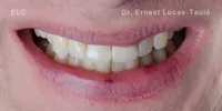 Close-up clinical view of the patient’s mouth with missing tooth replaced by an implant.