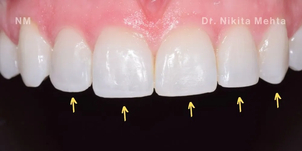 Close-up clinical view of the patient’s upper front teeth following edge bonding treatment. The biting edges are now perfectly straight, symmetrical, and smooth, complementing the previously corrected gum line and orthodontic alignment.