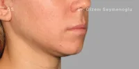Close-up clinical view of patient before Aqualyx treatment showing a double chin and excess submental fat, captured as a 'before' shot for fat-dissolving injection treatment.
