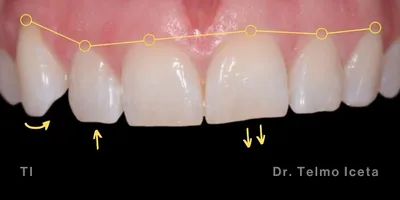 Close-up clinical view of a patient’s upper front teeth following orthodontic straightening and gum line correction. The teeth show minor unevenness and small chips at the biting edges, captured as a 'before' shot for dental edge bonding treatment.