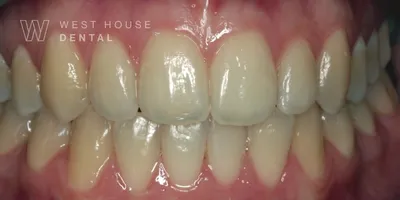 Before teeth whitening and composite bonding
