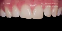 Close-up cinical view of a patient's upper front teeth showing fractures and jagged edges following a trauma incident.