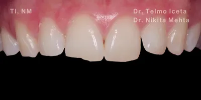 Close-up cinical view of a patient's upper front teeth showing fractures and jagged edges following a trauma incident.