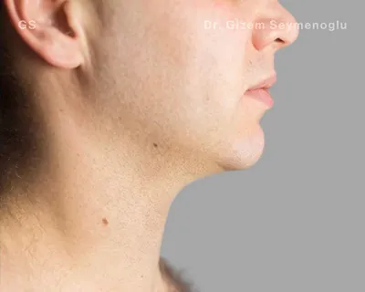 Close-up clinical view of patient after Aqualyx treatment showing a significant reduction in submental fat and a more contoured chin profile, captured as an 'after' shot for fat-dissolving injection treatment.