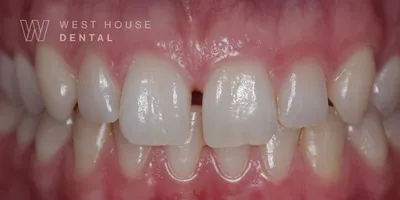 Close up clinical view of a patient’s mouth showing a gap between the upper front teeth.