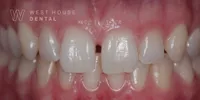 Close up clinical view of a patient’s mouth showing a gap between the upper front teeth.