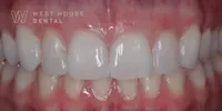 Close-up clinical view of the patient’s mouth following composite bonding treatment to close the gap between the upper front teeth.