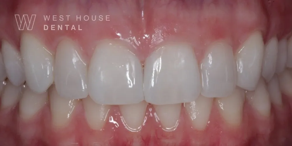 Close-up clinical view of the patient’s mouth following composite bonding treatment to close the gap between the upper front teeth.
