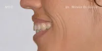 Close-up clinical view of the patient’s upper front teeth following edge bonding treatment. The biting edges are now perfectly straight, symmetrical, and smooth, complementing the previously corrected gum line and orthodontic alignment.