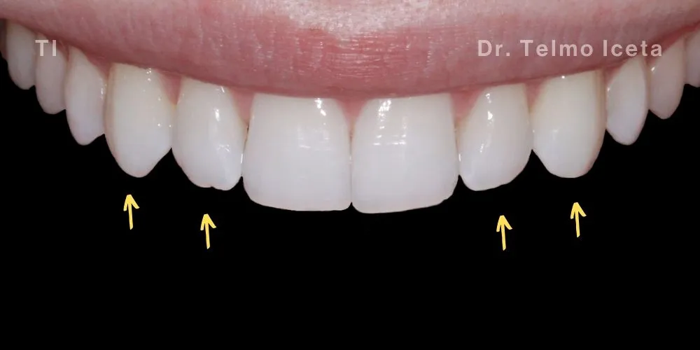 Close-up clinical view of the patient’s upper front teeth following teeth straightening and whitening treatment.