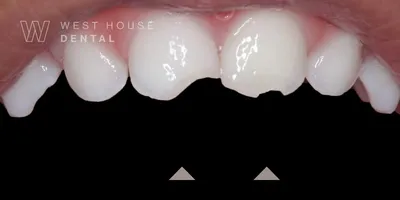 Close-up of a 36-month-old child’s upper front primary teeth showing fractures and jagged edges following a trauma incident