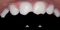 Close-up of a 36-month-old child’s upper front primary teeth showing fractures and jagged edges following a trauma incident
