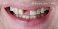 Close-up clinical view of a patient’s mouth with missing upper center tooth.