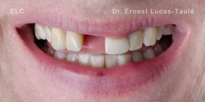 Close-up clinical view of a patient’s mouth with missing upper center tooth.