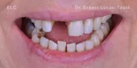 Close-up clinical view of a patient’s mouth with missing upper center tooth.