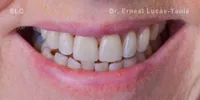 Close-up clinical view of the patient’s mouth with missing tooth replaced by a same-day implant.