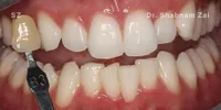 Close-up clinical view of the patient’s upper front teeth following edge bonding treatment. The biting edges are now perfectly straight, symmetrical, and smooth, complementing the previously corrected gum line and orthodontic alignment.