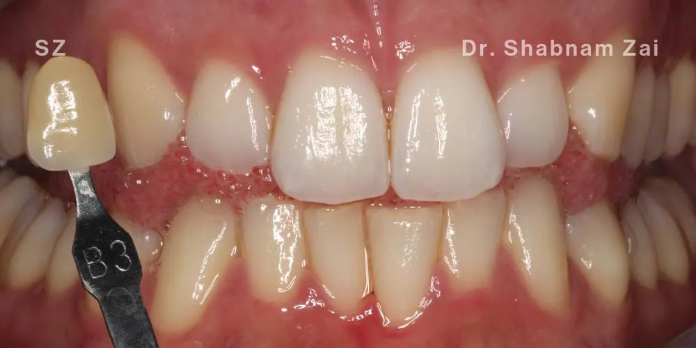Close-up clinical view of a patient’s teeth prior to teeth whitening treatment. The teeth show a yellowish hue (B3 shade), captured as a 'before' shot for dental whitening treatment.