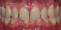 Close-up clinical view of a patient’s upper front teeth following orthodontic straightening and gum line correction. The teeth show minor unevenness and small chips at the biting edges, captured as a 'before' shot for dental edge bonding treatment.